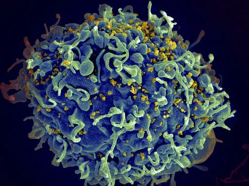 This electron microscope image made available by the U.S. National Institutes of Health shows a human T cell, in blue, under attack by HIV, in yellow, the virus that causes AIDS. Hard-won progress against HIV has stalled, putting millions of lives at risk, according to an alarming report Wednesday, July 27, 2022 on how the collision with the COVID-19 pandemic and other global crises is jeopardizing efforts to end AIDS. The report from UNAIDS is being released ahead of the start of the Internatio