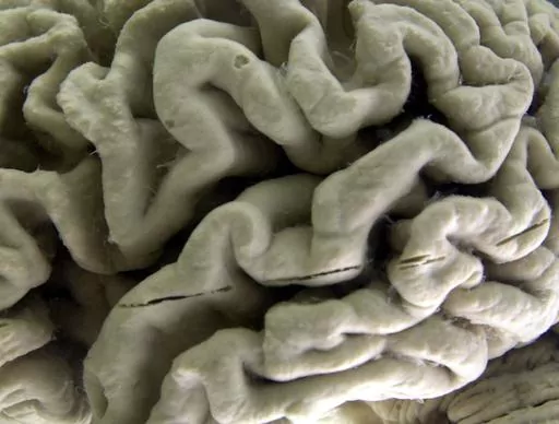 A closeup of a human brain affected by Alzheimer's disease, is displayed at the Museum of Neuroanatomy at the University at Buffalo in Buffalo, N.Y., on Oct. 7, 2003. According to findings published Wednesday, Feb. 21, 2024 in the New England Journal of Medicine, Alzheimer’s quietly ravages the brain long before symptoms appear and now scientists are getting a closer look at the domino-like sequence of those changes _ a potential window to one day intervene. (AP Photo/David Duprey)